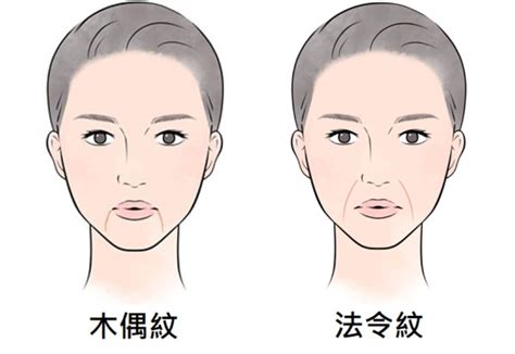 木偶紋|【木偶紋】5大形成原因+預防方法與醫美療程 